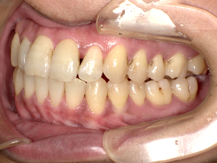 インビザラインの症例