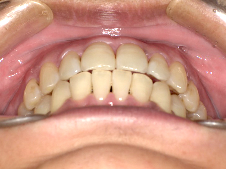 インビザラインの症例