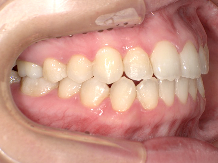 インビザラインの症例
