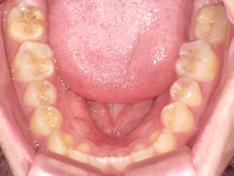 インビザラインの症例