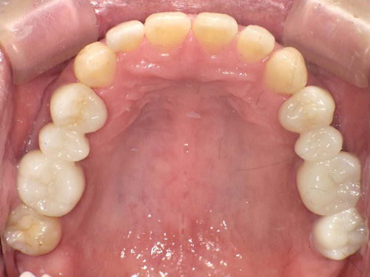 インビザラインの症例