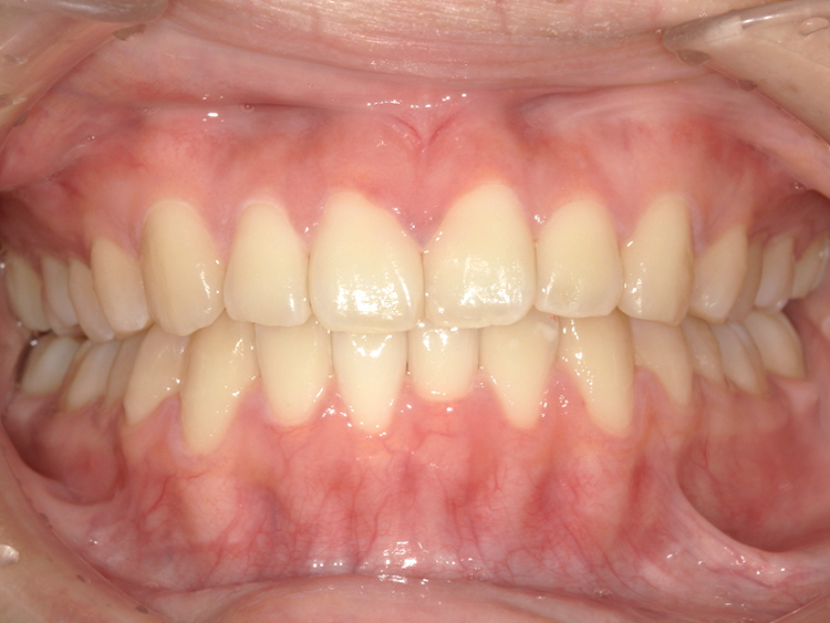 インビザラインの症例