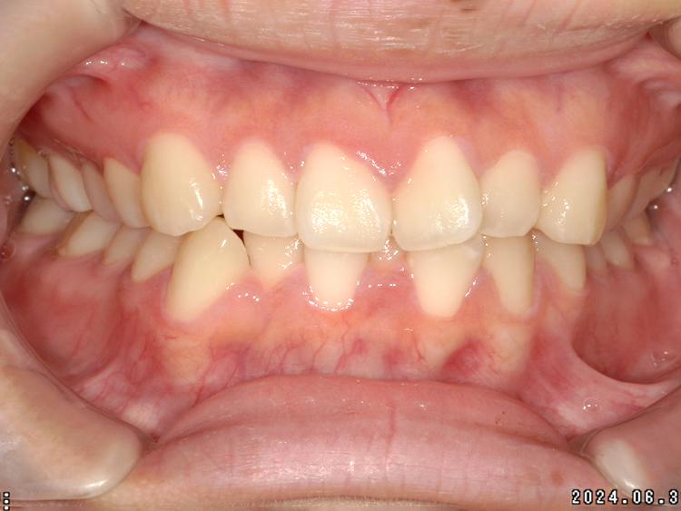 インビザラインの症例