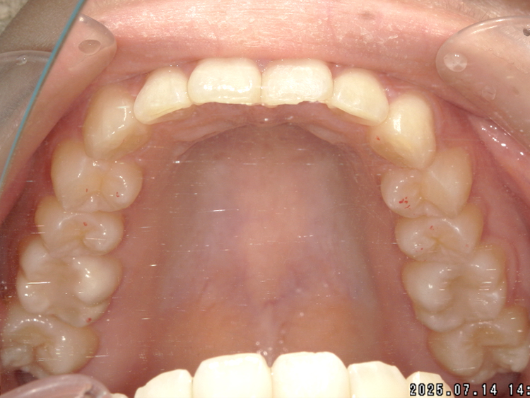 インビザラインの症例