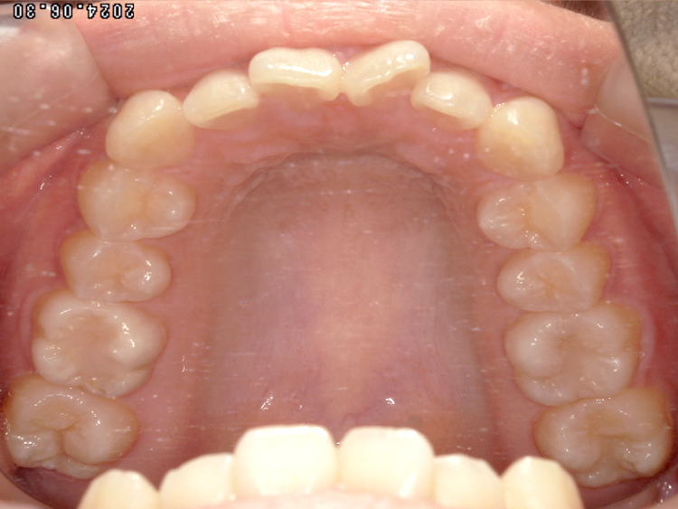 インビザラインの症例