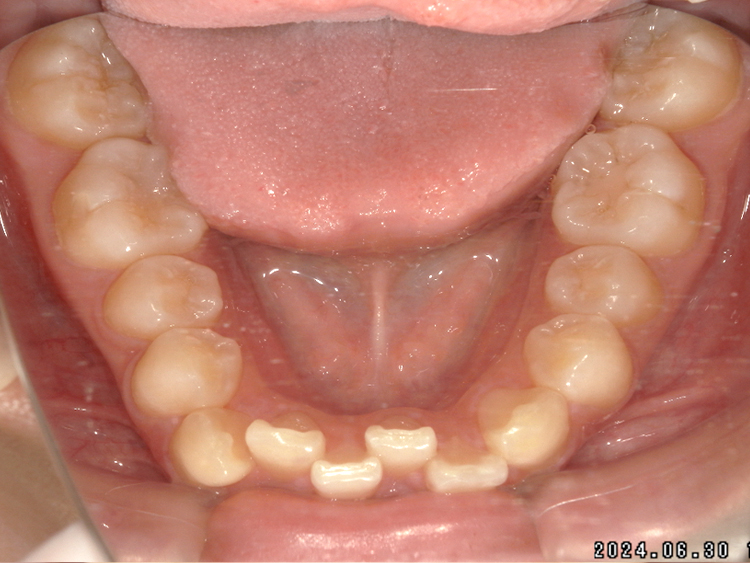 インビザラインの症例