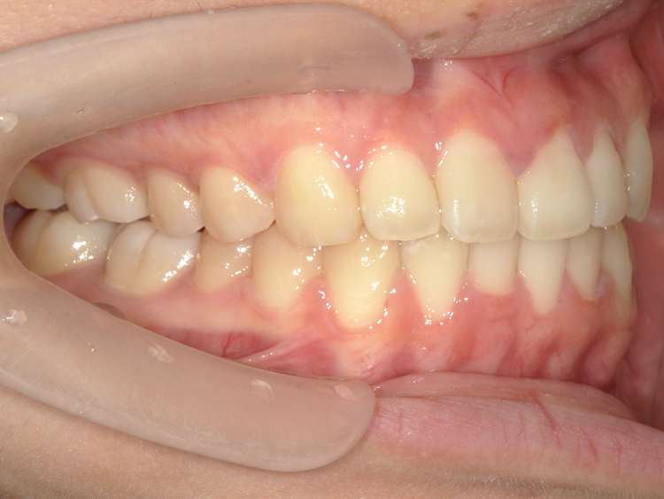 インビザラインの症例