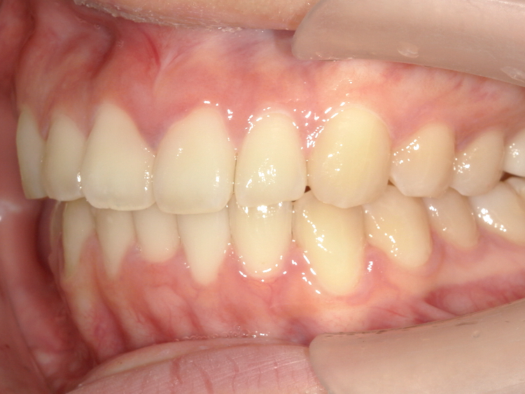 インビザラインの症例