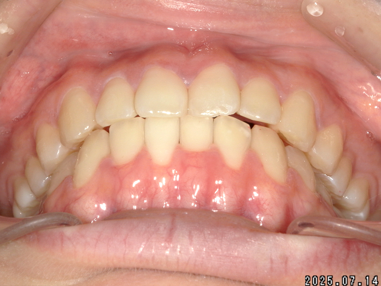 インビザラインの症例