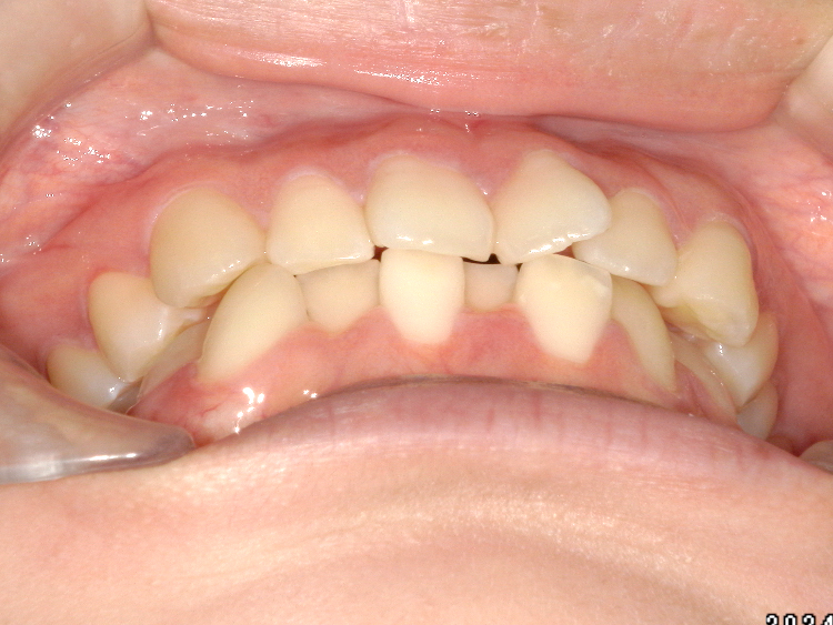 インビザラインの症例