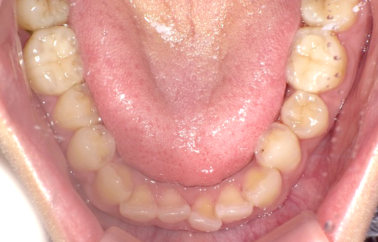 部分矯正の症例