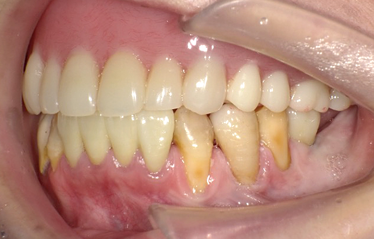 審美歯科の症例